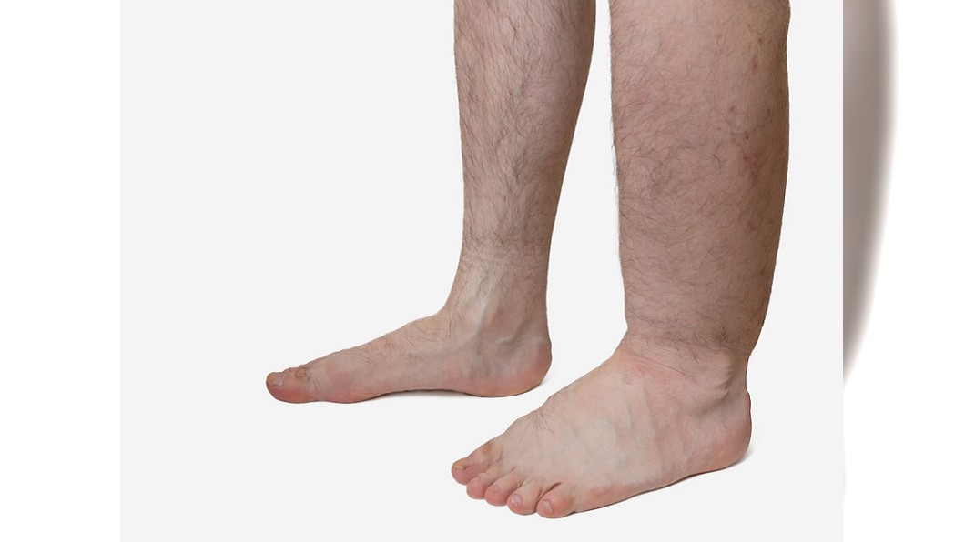 以為肌肉痠痛腿腫半年 竟是輸尿管長「腫瘤」