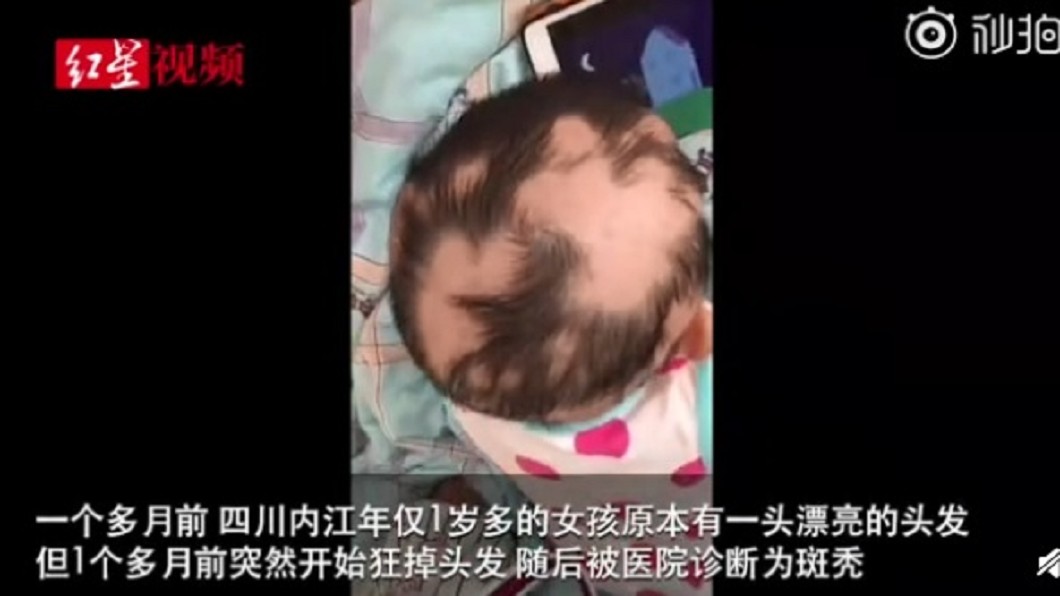 1歲女童狂落髮慘變鬼剃頭 母心疼控訴「全是它害的」
