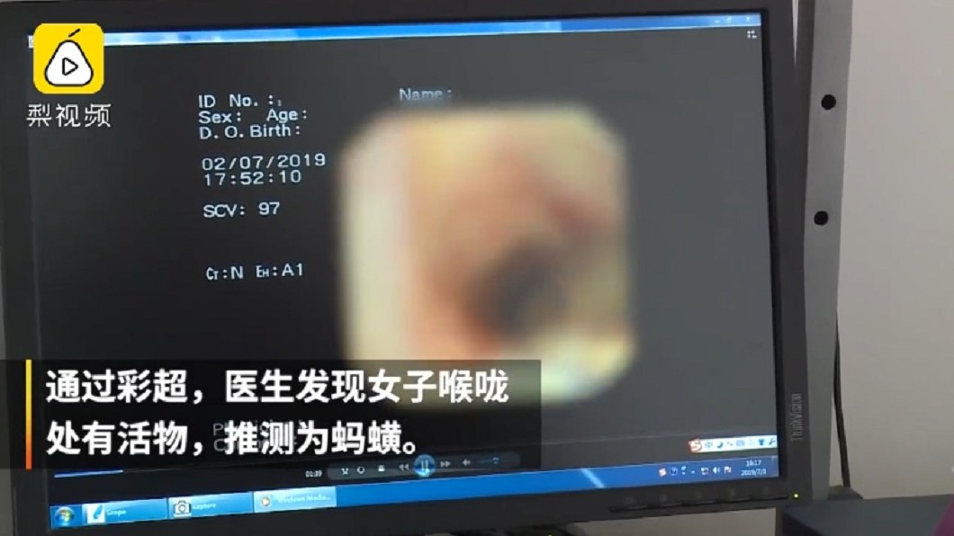 飲生泉水咳出血 婦氣管驚見3公分水蛭蠕動