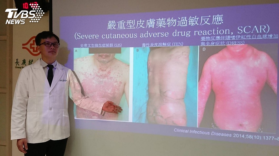 長庚醫院醫師公布民眾因使用治療青春痘藥物導致出現全身紅腫過敏反應的案例。(圖／中央社，TVBS)