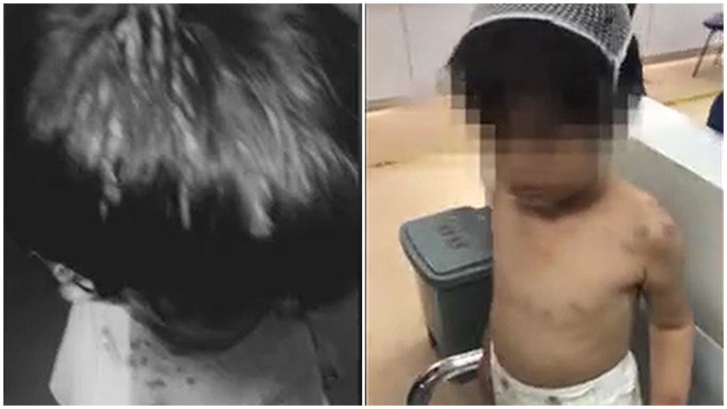 虐打6歲孫女滿身傷還有菸疤 阿嬤稱:她自己弄的
