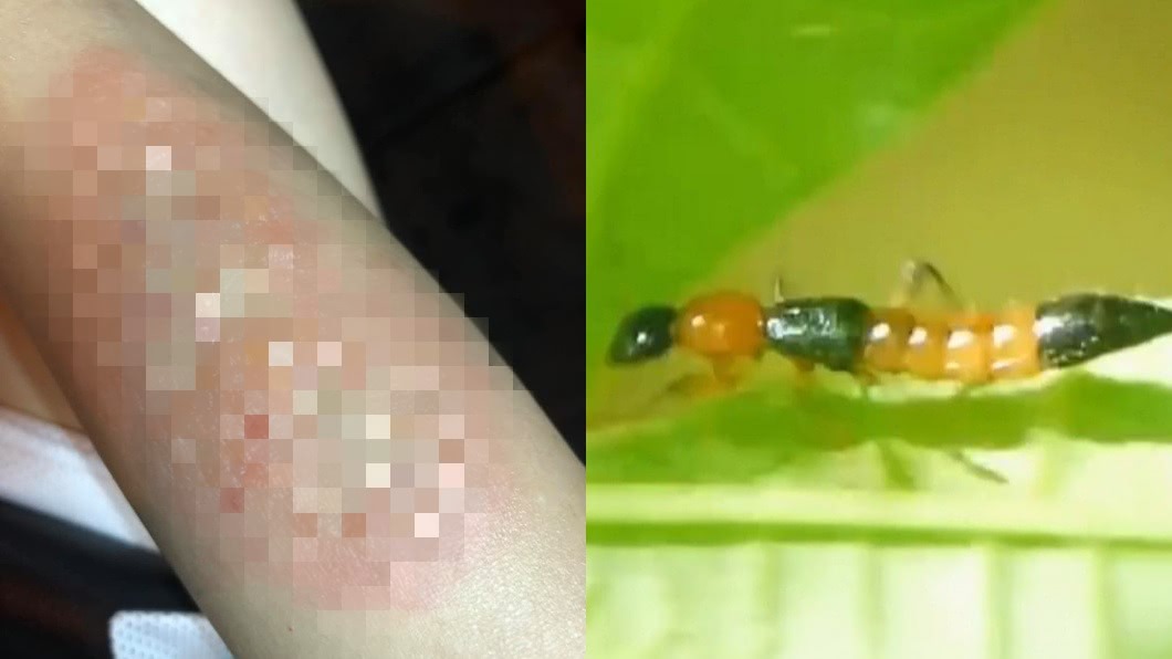 不知隱翅蟲！她順手打爆…崩潰PO照勸世：這就是下場