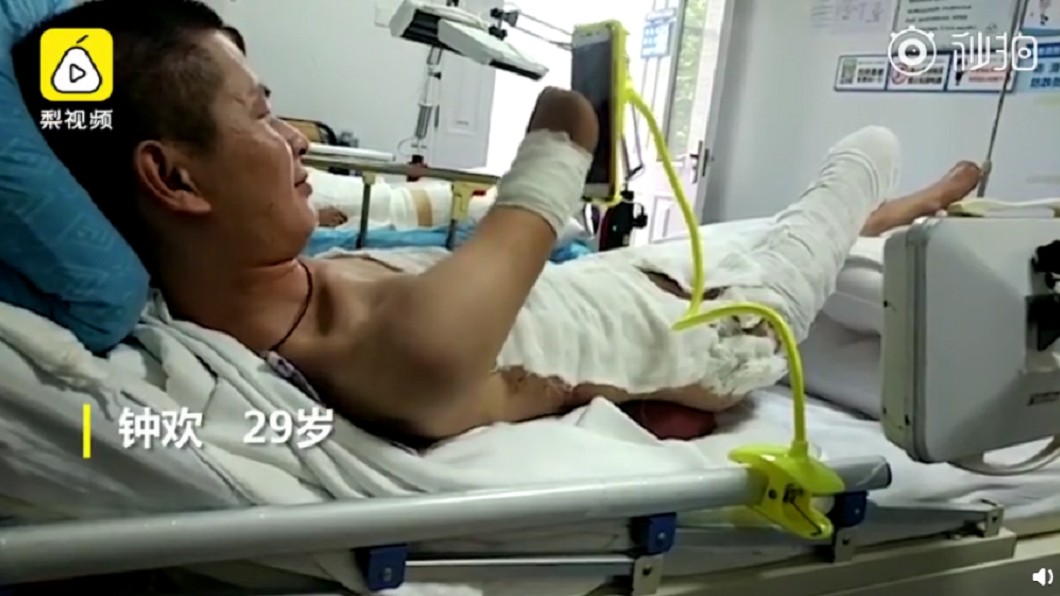 誤觸高壓電!男子四肢燒成焦炭截肢 女兒一句話暖哭眾人