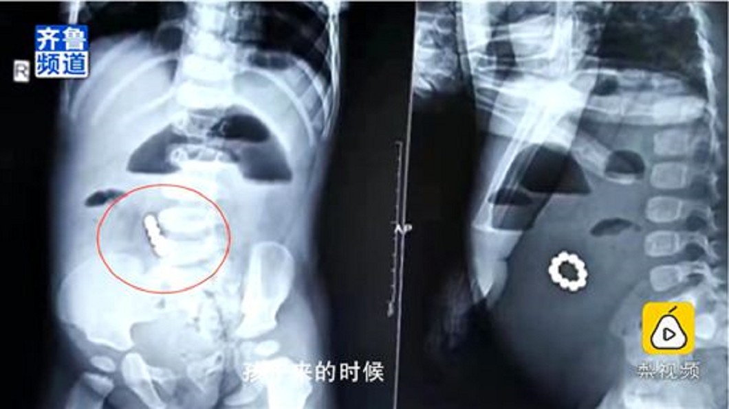 男童吞下磁力珠 肚內串成「手環」險喪命