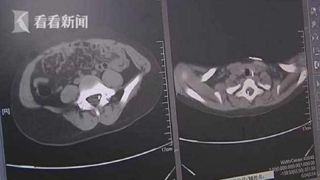 8歲童走路不穩 意外發現體內竟卡「3根針」