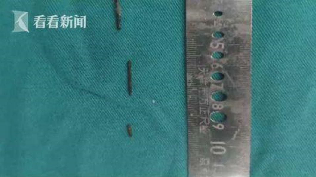 男童體內竟卡3根鋼針。圖/翻攝自微博