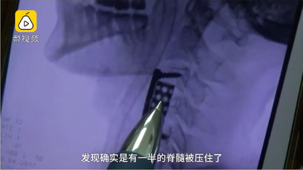 一名婦人每天打麻將超過10小時,日前玩到一半卻出現無法動彈的情況。(圖/翻攝自梨視頻)