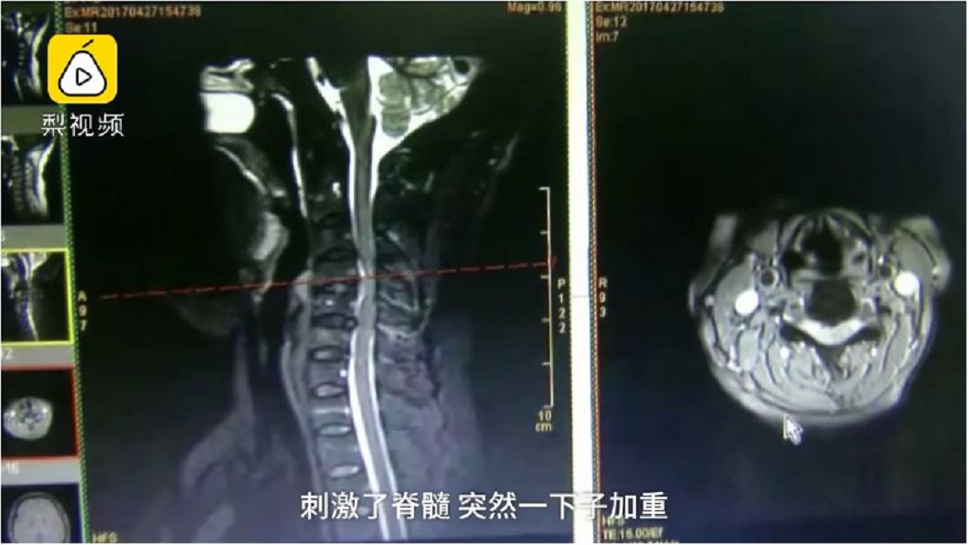 最後醫師診斷她是得了「脊髓半切綜合症」。(圖/翻攝自梨視頻)