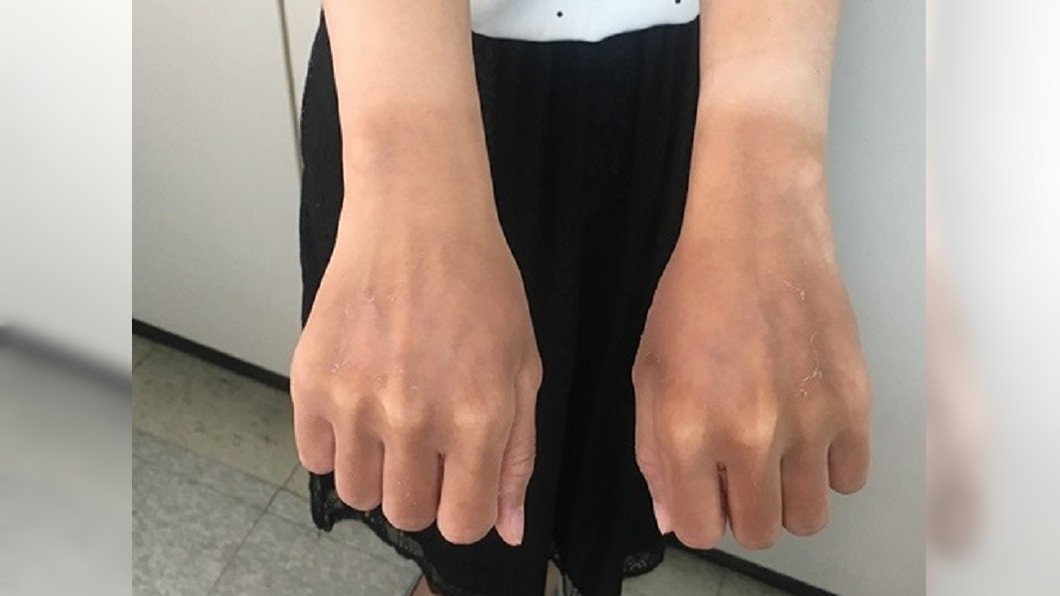 妙齡女曬成「巧克力手」 快吃4大類食物「白回來」