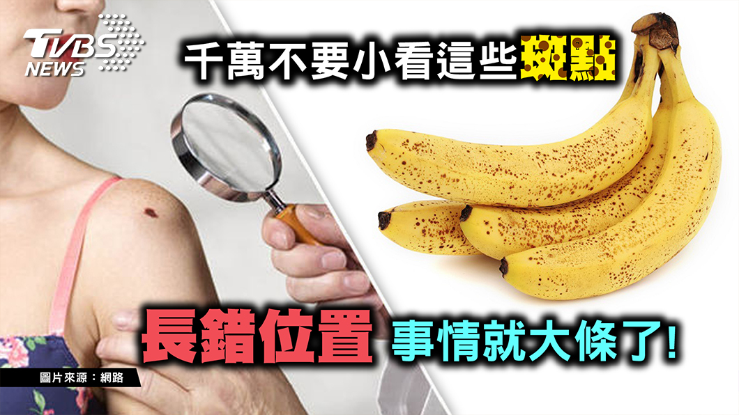 這款痣竟可能「痣」癌 ?! 看到異狀千萬別輕忽