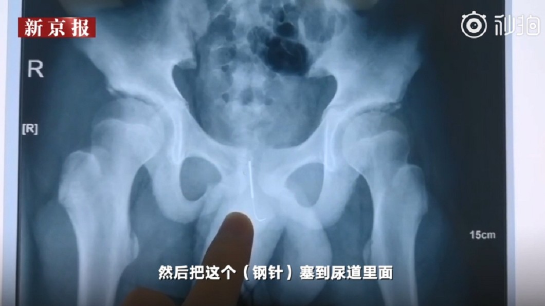 男童作業寫一半想提神 竟把「10cm銀針」插進尿道