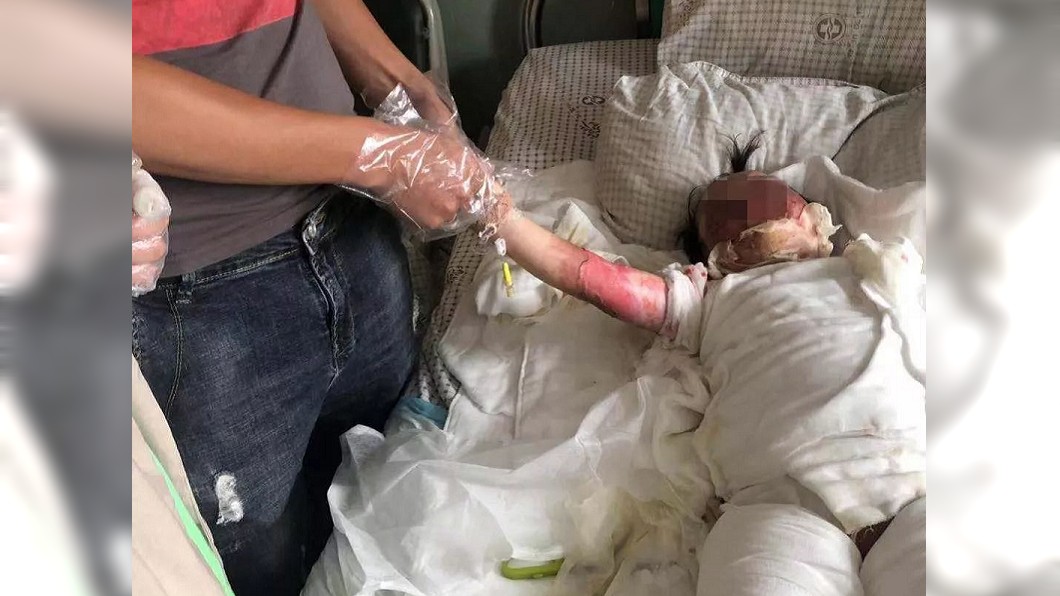 女童跌進炸油鍋 父母幫脫衣卻撕下整片皮