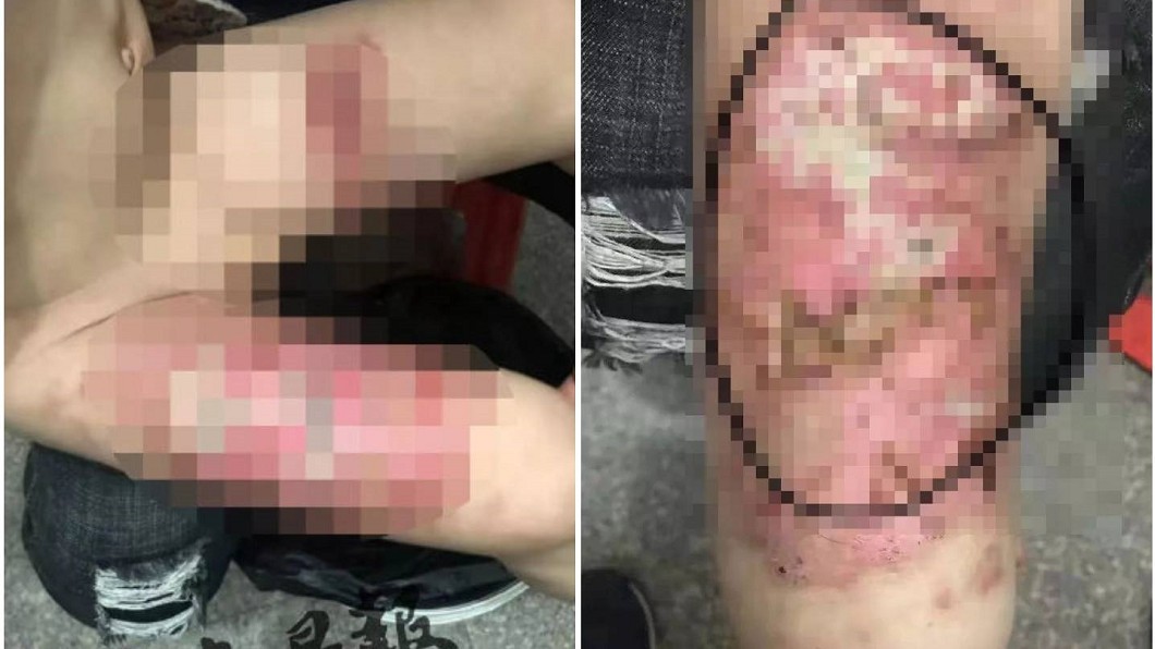 男童去年4月大腿被大面積燙傷。合成圖/翻攝東南早報、泉州熱門