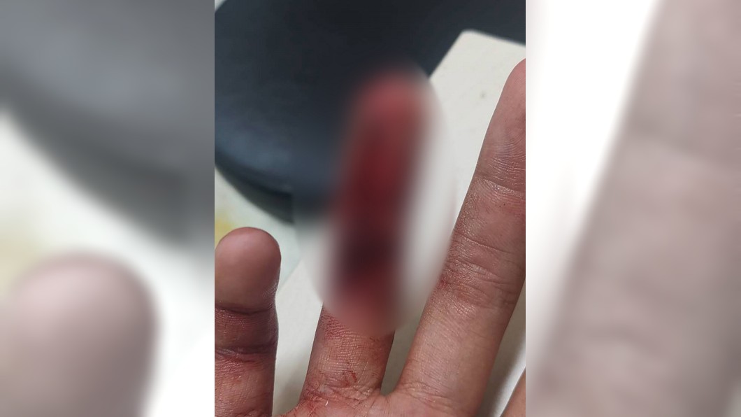 國中畢業生蓋火鍋 手指遭籃球鐵網割傷縫26針