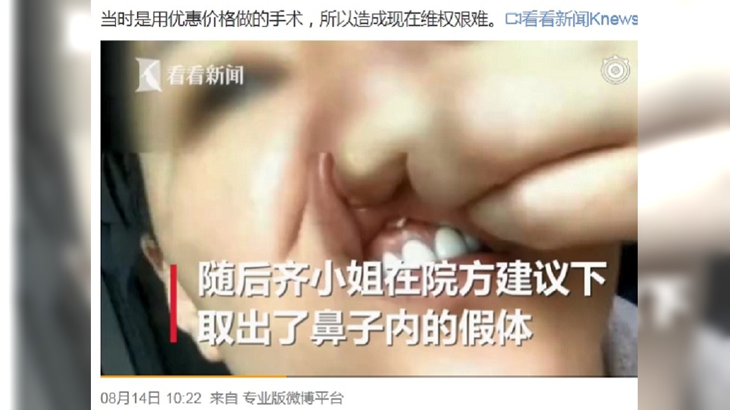 2女揪整形!1年後鼻噴膿汁「嘴掉異物」 崩潰想哭