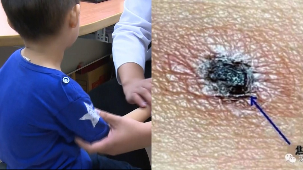 旅遊回來…狂高燒「身冒詭異焦疤」 7歲童染這病險死