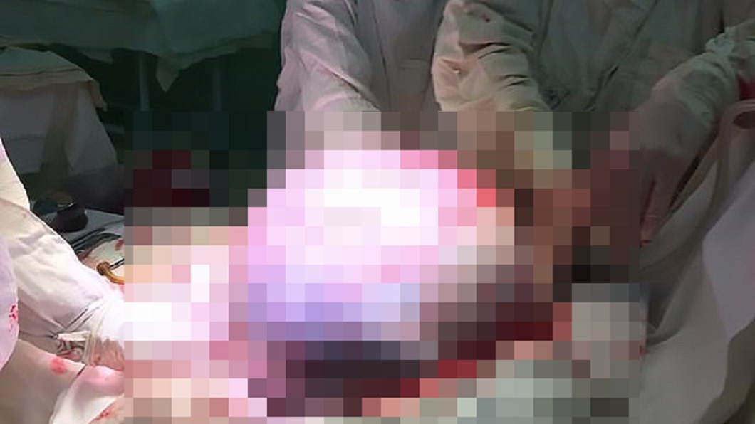 悚!婦人呼吸困難求診 竟取出巨大「沙灘球」腫瘤