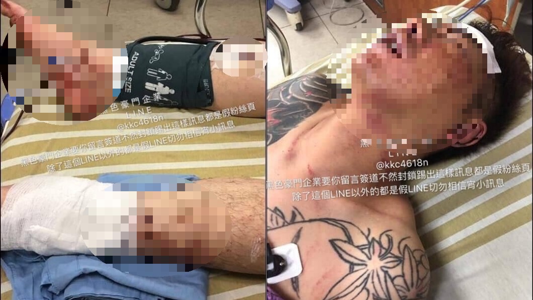 影/吳小哲遭斷手腳後首露面! 爆哭:對不起爸爸