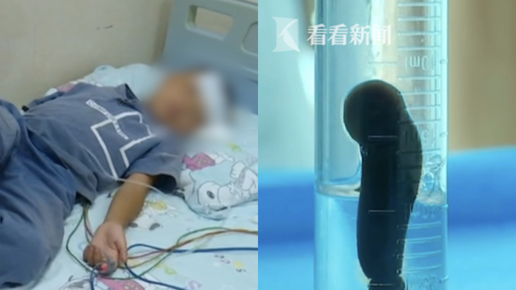 男童狂咳嘔鮮血！醫一看…喉嚨藏「蠕動異物」嚇傻