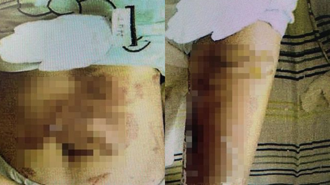 被講「非處女」!她怒罵男友 竟遭熱湯潑「多塊皮肉掉」