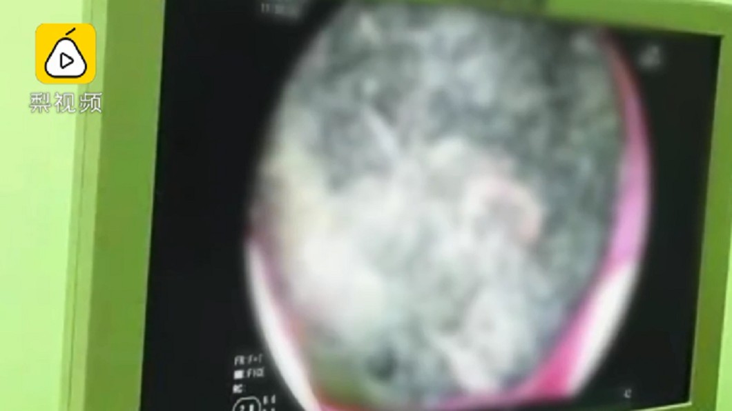 女童腹痛就醫 開刀竟取出「這東西」揭詭異癖好