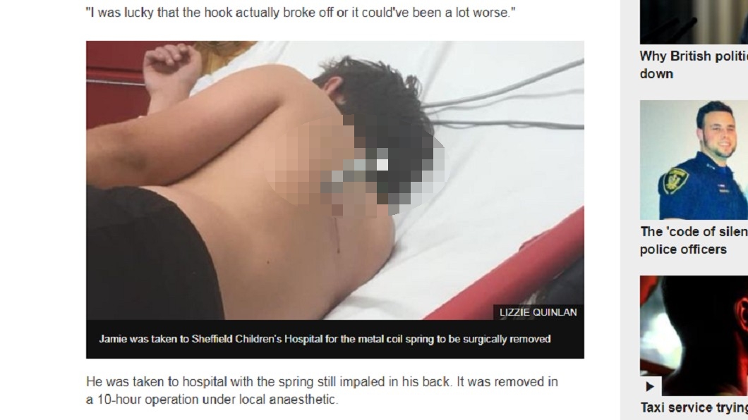 玩跳床要小心!男子被「暗器」插傷背部無大礙