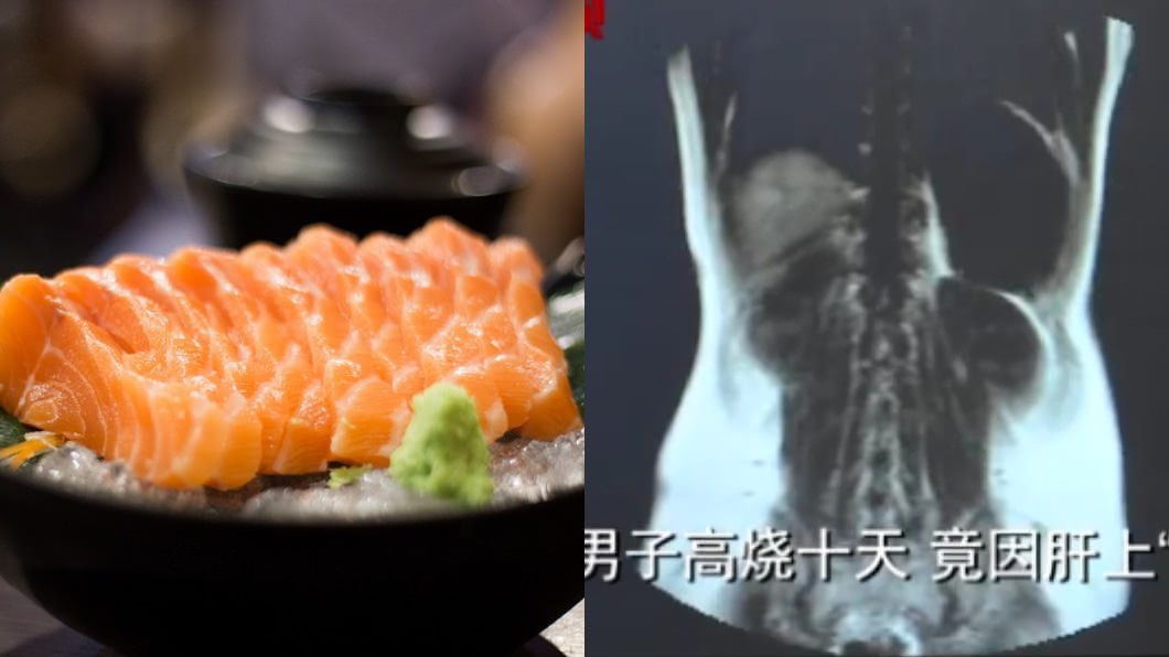 男吃生魚片3年　照X光驚見「密麻活蟲」狂啃咬肝臟