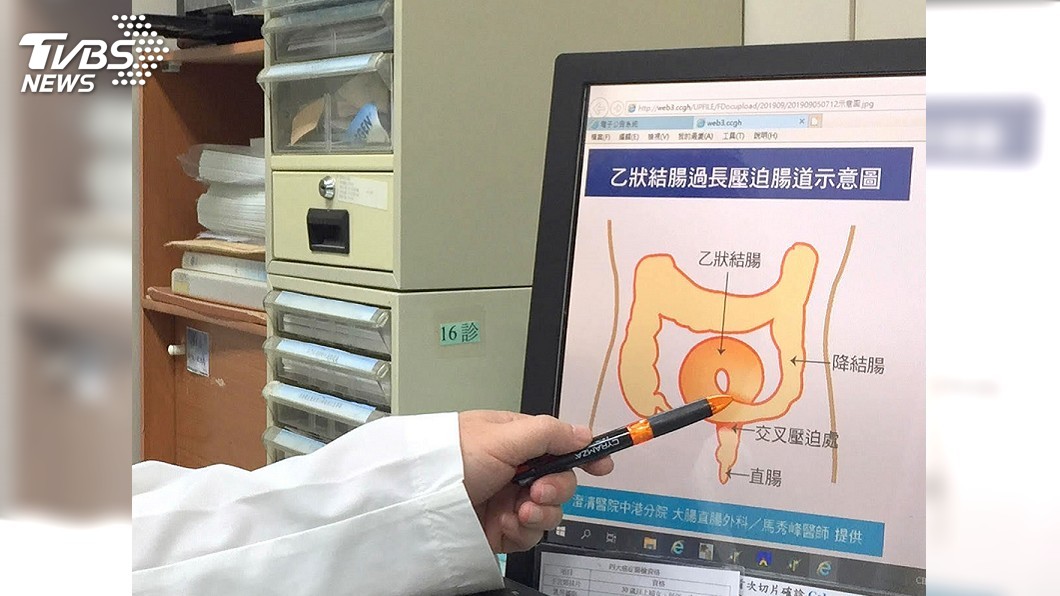 先天乙狀結腸過長 男子腹脹腸道積便如車輪