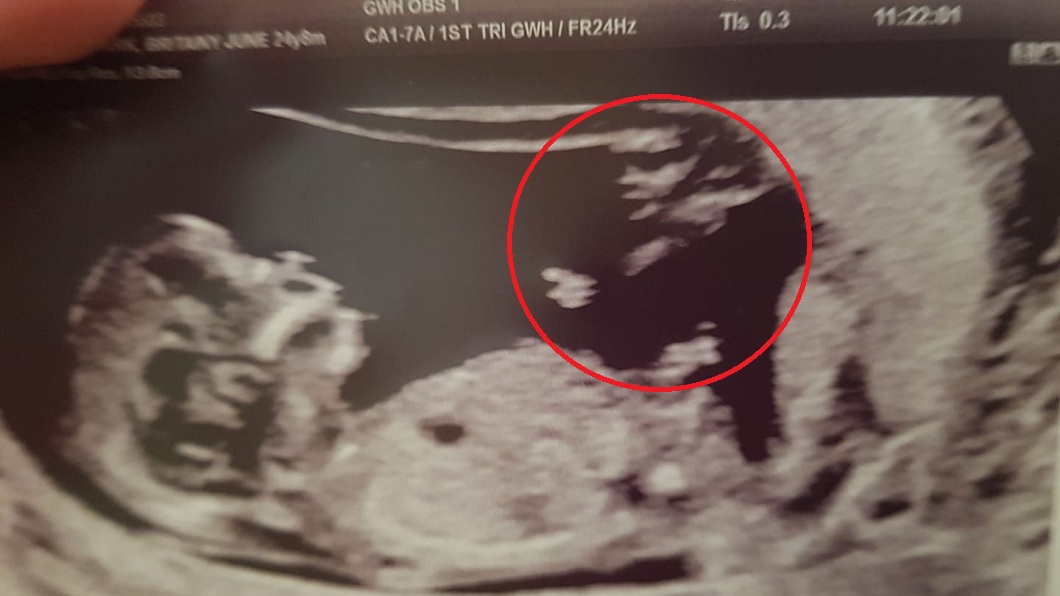 英國1位婦人被檢查出難以懷孕,但日前就醫發現懷孕了,照超音波發現腹中胎兒旁邊有1個天使。(圖/翻攝自臉書)