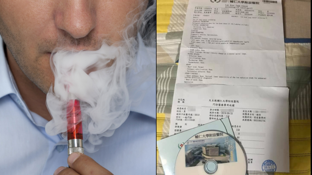 胸肺劇痛!他抽電子煙半年 做斷層見「2異物」嚇壞