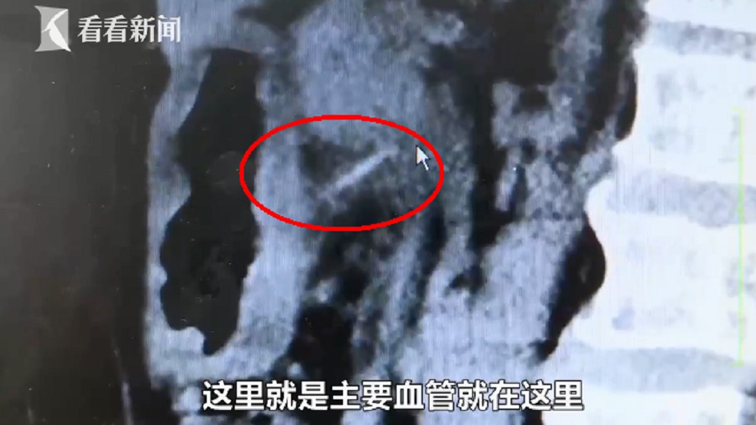 醫師發現6公分尖銳物刺穿胃壁。圖/翻攝自看看新聞
