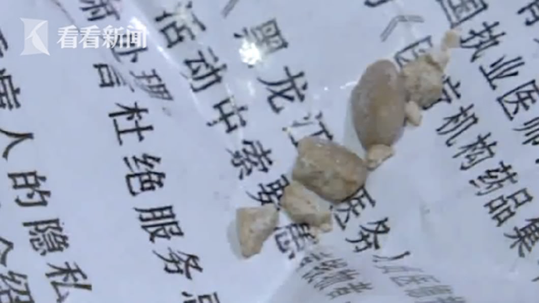 大陸黑龍江1名25個月大的男童無法正常小便，送醫檢查竟發現他的生殖器卡了2顆乳白色結石圖／翻攝自看看新聞