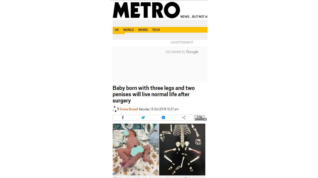 俄羅斯1名婦女的孩子出生後有3條腿、2生殖器且沒有肛門。圖/翻攝自metro網站