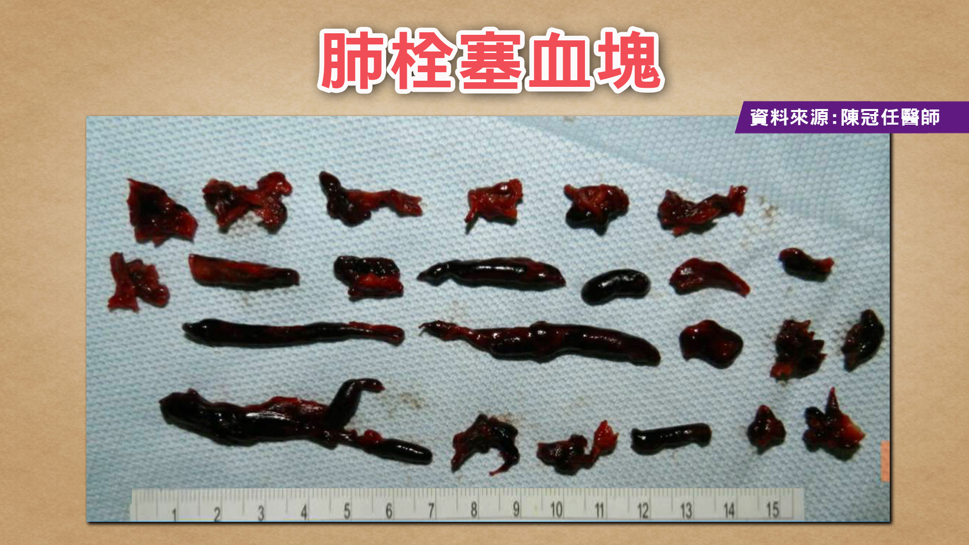扭到腳竟致命 其實肺栓塞比心肌梗塞更兇猛