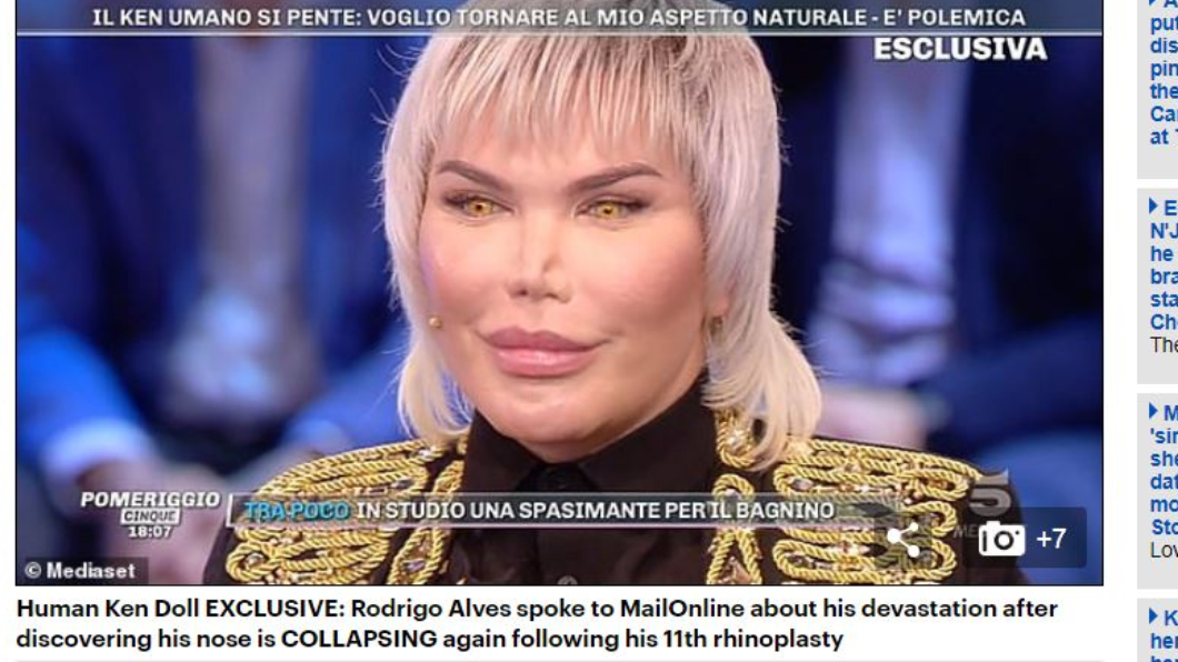 Rodrigo Alves的鼻子已開始塌陷。翻攝/Daily Mail