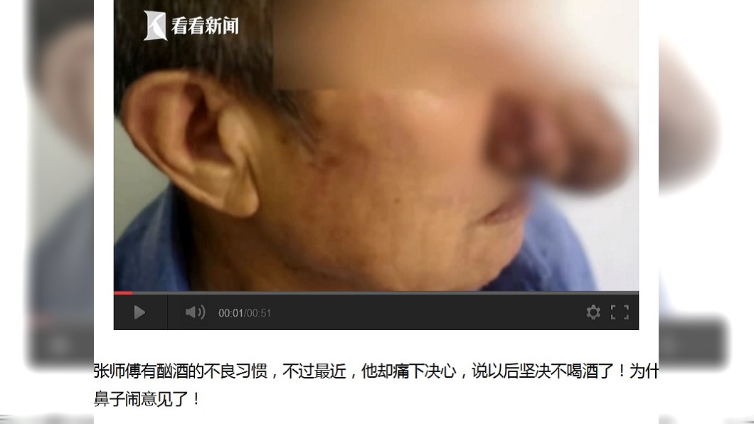 酗酒10年「每天狂飲1瓶」 78歲翁長出巫婆鼻險亡