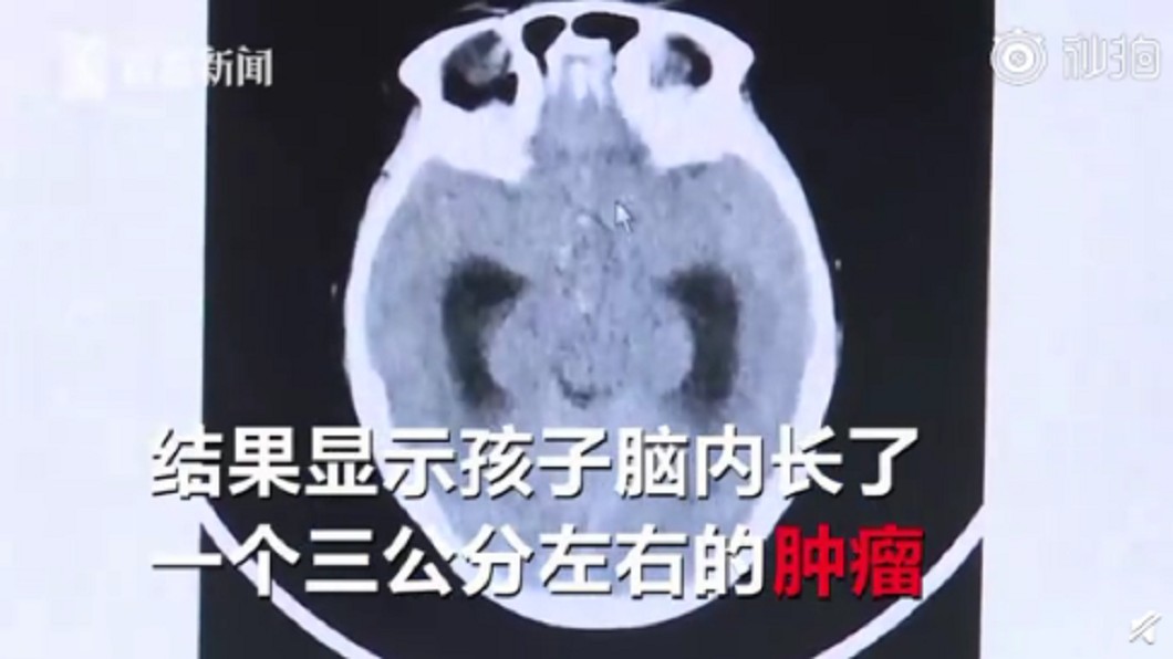 醫師發現男童腦部長出了一個約3公分的的腫瘤。圖/翻攝自看看新聞