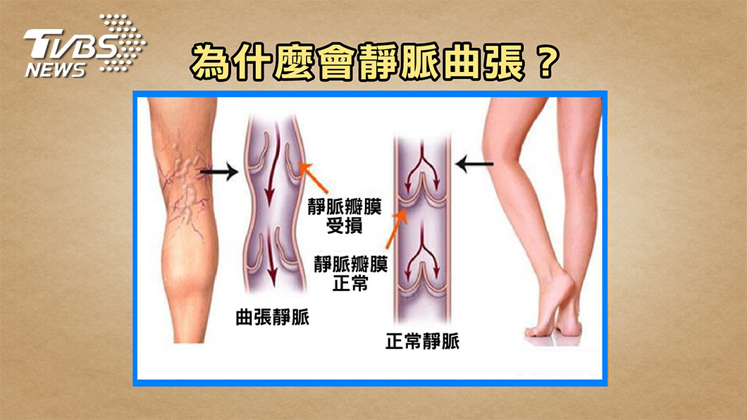 靜脈曲張這狀況千萬別亂揉 小心一揉導致肺栓塞