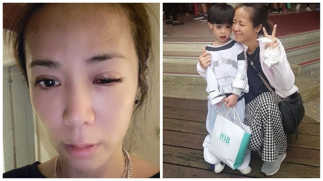 被兒小手插破眼球 女星po腫眼照嘆:媽媽真辛苦