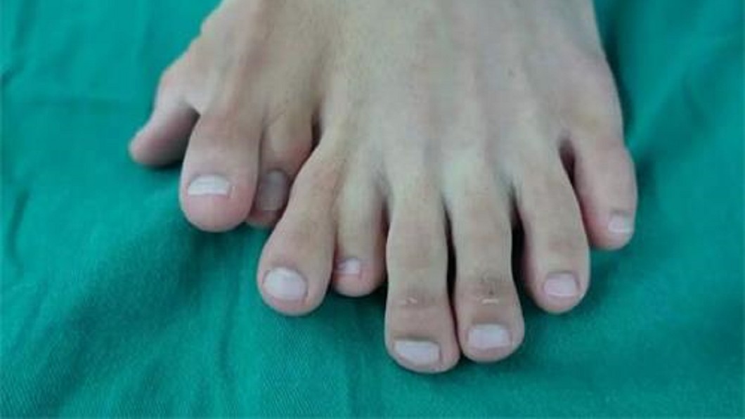 清秀男「一腳長9隻腳趾」…忍受多年沒就醫全因1句話