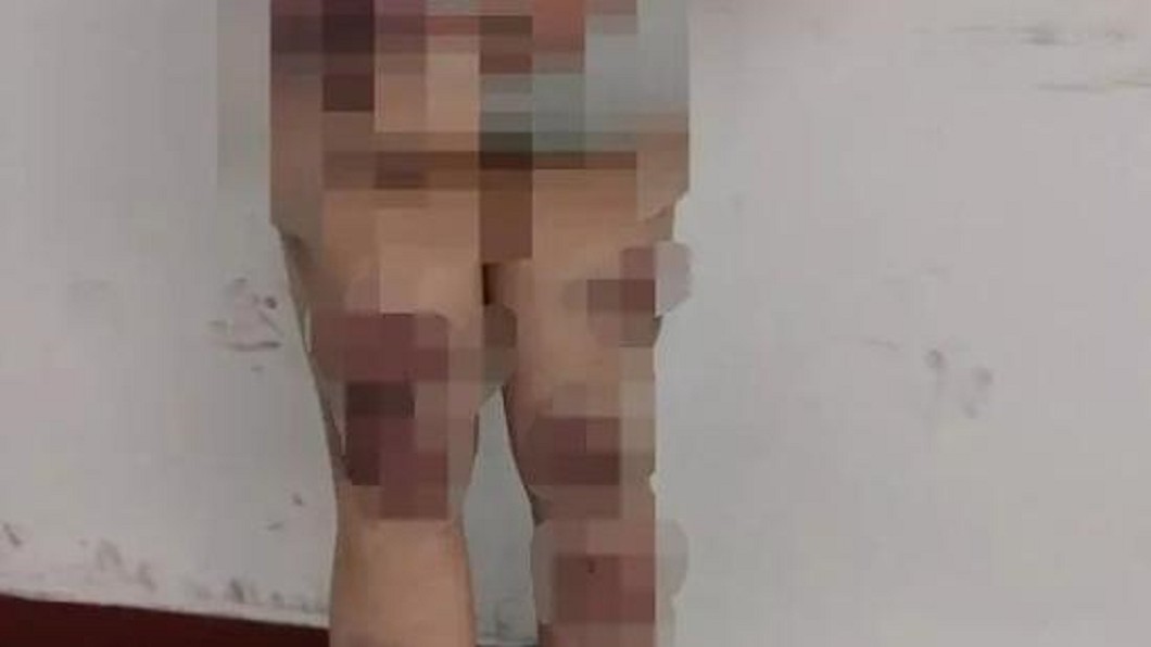 林姓女兒全身多處瘀傷。圖/翻攝自微信