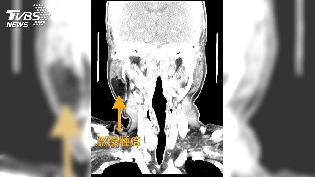 男耳下腫脹誤認是「豬頭皮」 影響進食才知腫瘤上身
