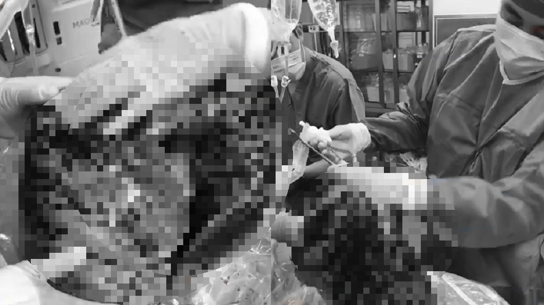 抽菸30年死後器捐 醫見「恐怖黑肺」搖頭:沒人要
