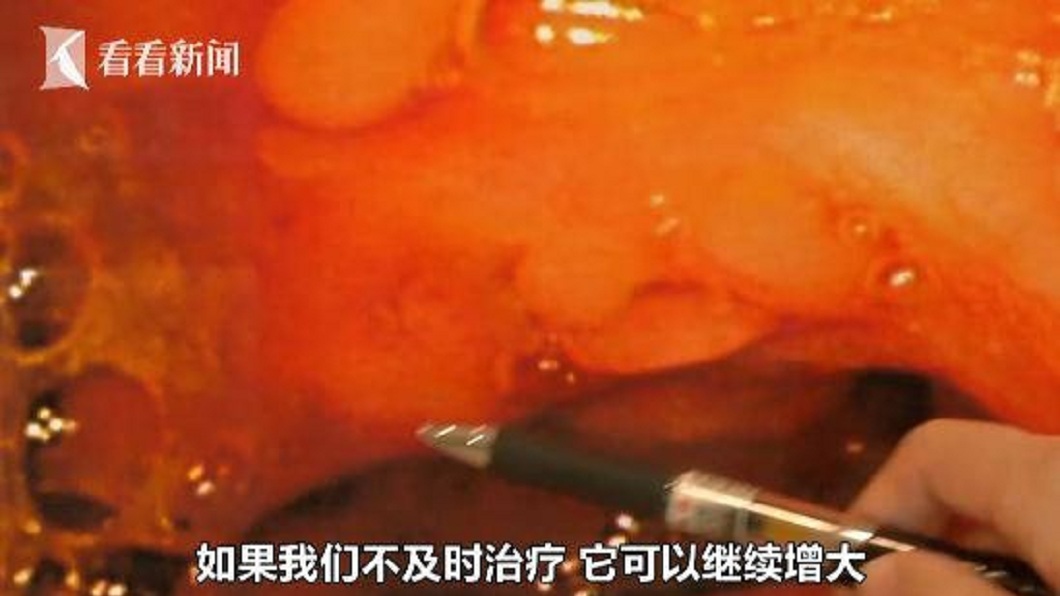 愛吃辛辣抽菸喝酒 男腸道長60顆「肉色珍珠」