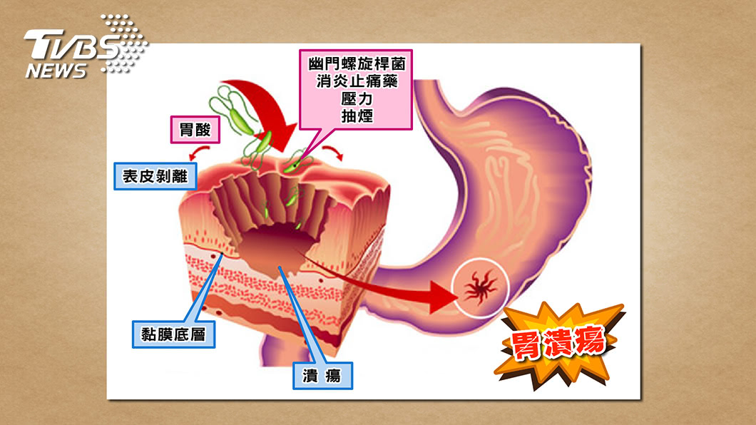 天氣變冷溫差大 胃脹又悶痛? 小心是胃潰瘍發作