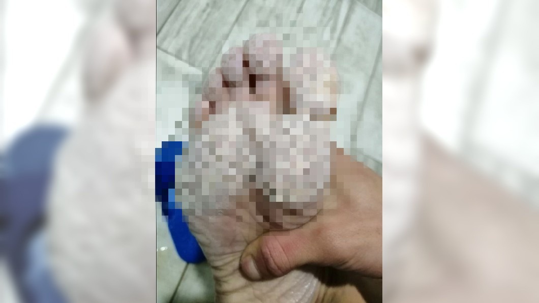 慎入!男一脫濕襪驚見「密麻坑洞」 網嚇:快就醫