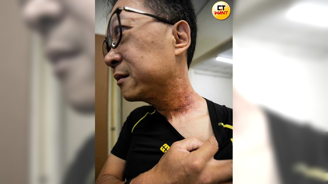 為了防止癌細胞擴散，進行多次化療的吳慎昌，連唾液腺都受損。（圖／CTWANT授權）