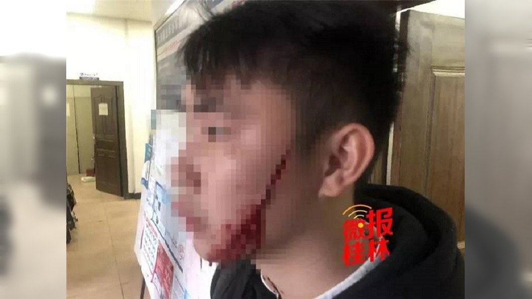 分手擁抱告別!她狠割10cm嘴邊肉 男友毀容崩潰