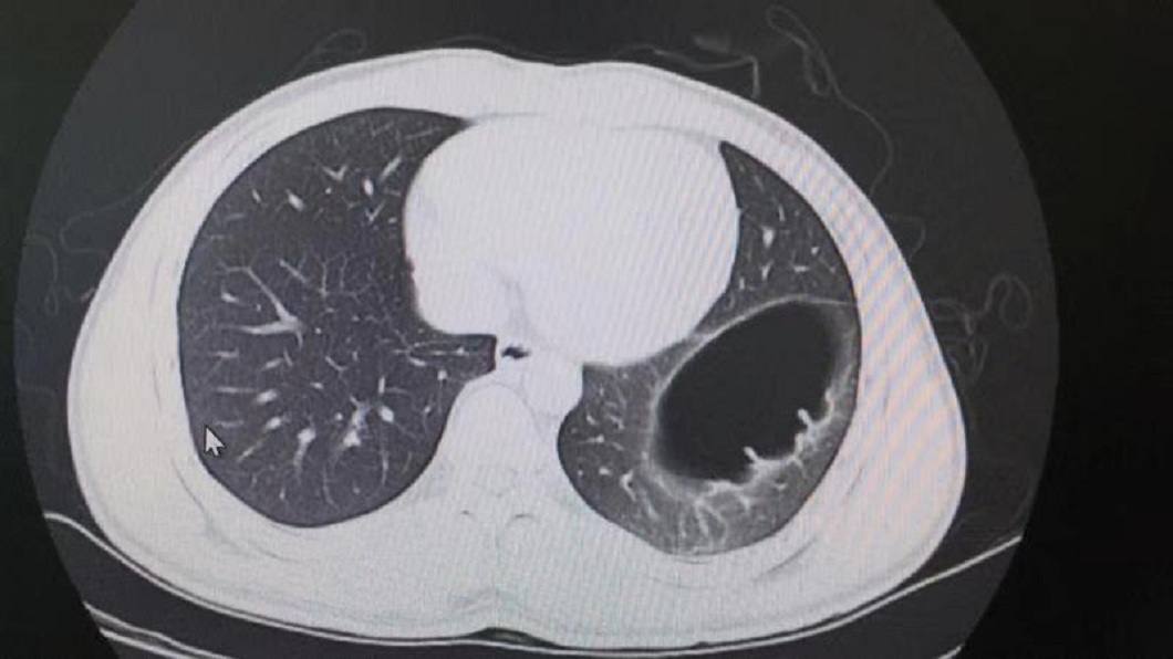 廣州1名男子遭女友輕拍腹部一下,竟然出現劇痛,檢查後發現臟器移位。(圖/翻攝自陸網)