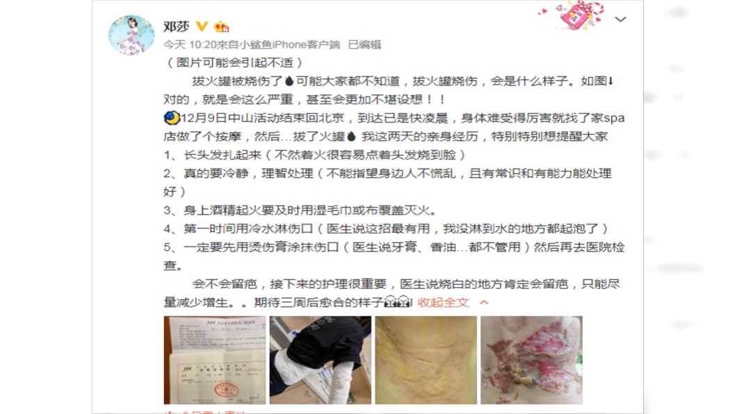 鄧莎嚴重燒傷。圖/翻攝自鄧莎微博